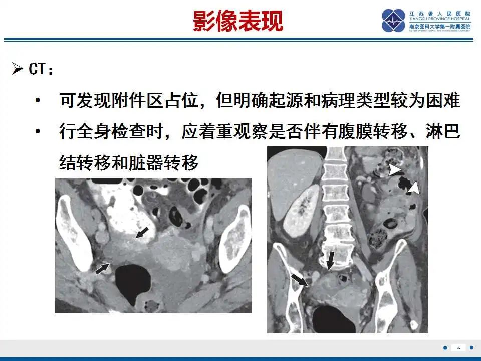 【PPT】原发性输卵管癌-27
