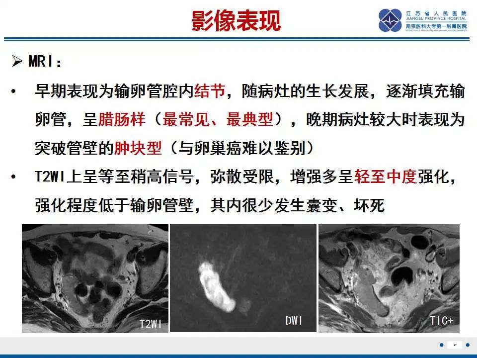 【PPT】原发性输卵管癌-28