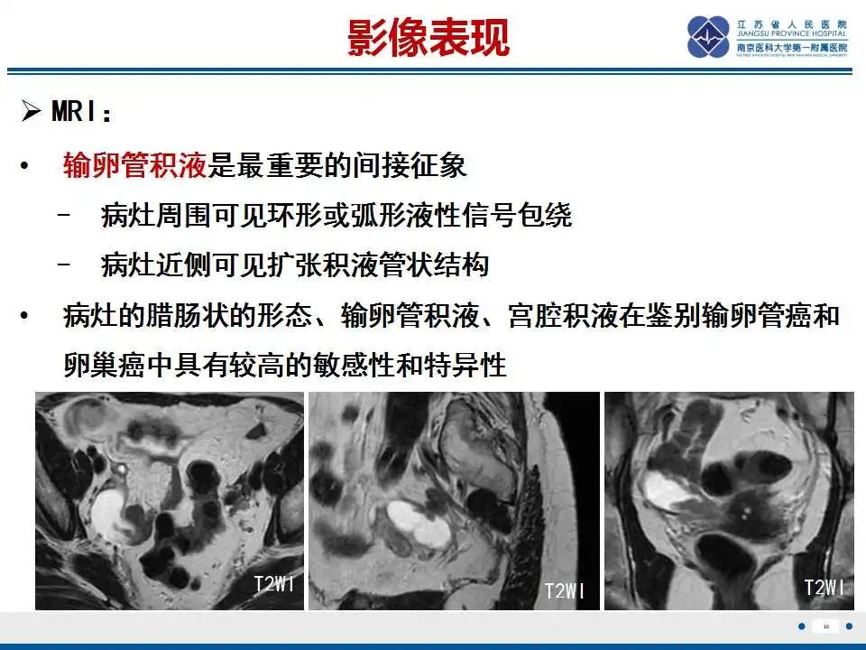 【PPT】原发性输卵管癌-29