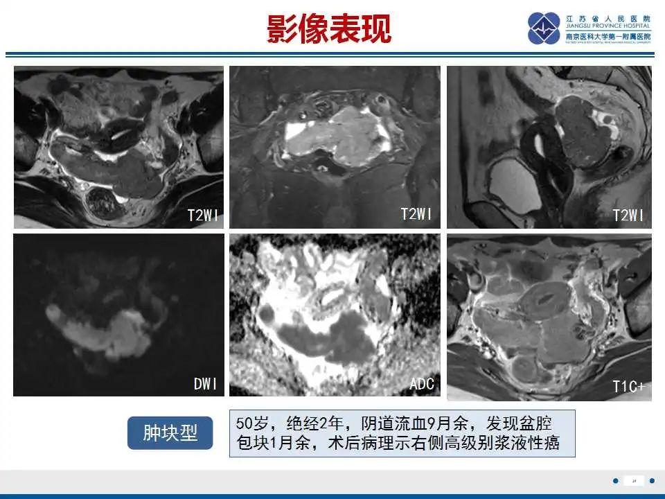 【PPT】原发性输卵管癌-32