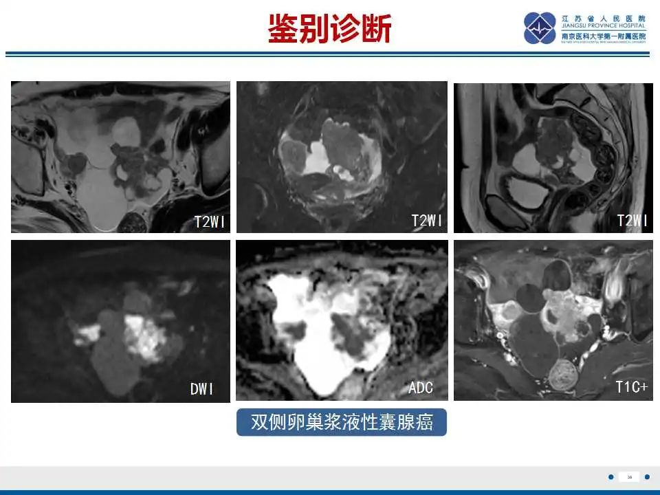 【PPT】原发性输卵管癌-39
