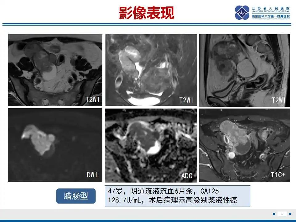 【PPT】原发性输卵管癌-31