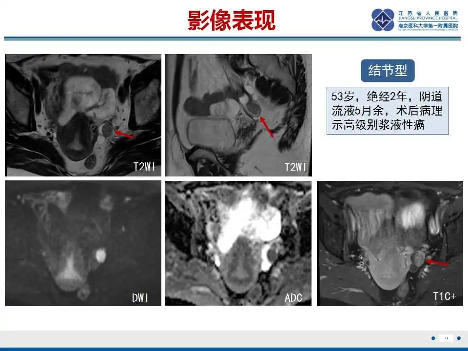 【PPT】原发性输卵管癌-7