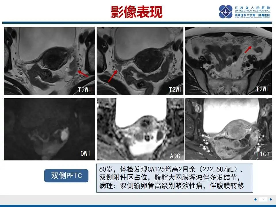 【PPT】原发性输卵管癌-9