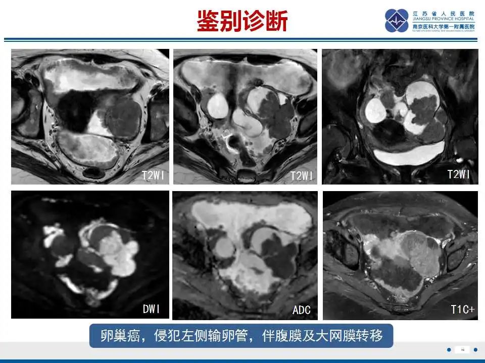 【PPT】原发性输卵管癌-12