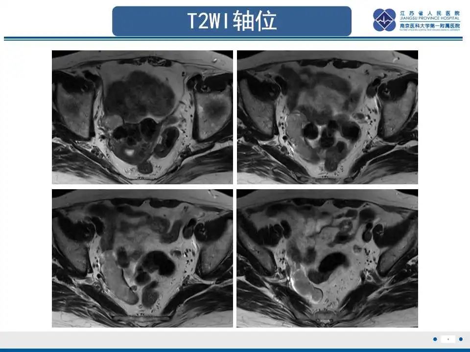 【PPT】原发性输卵管癌-1