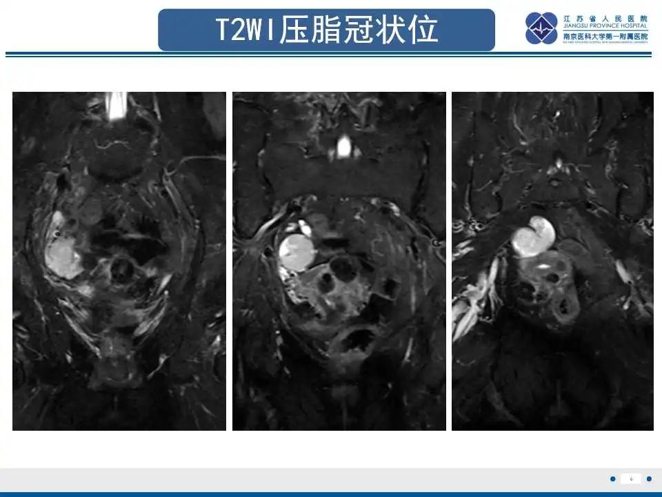 【PPT】原发性输卵管癌-1