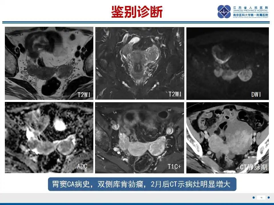 【PPT】原发性输卵管癌-2
