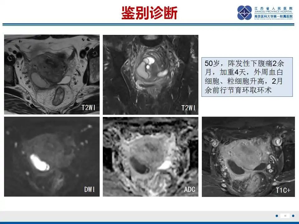 【PPT】原发性输卵管癌-3