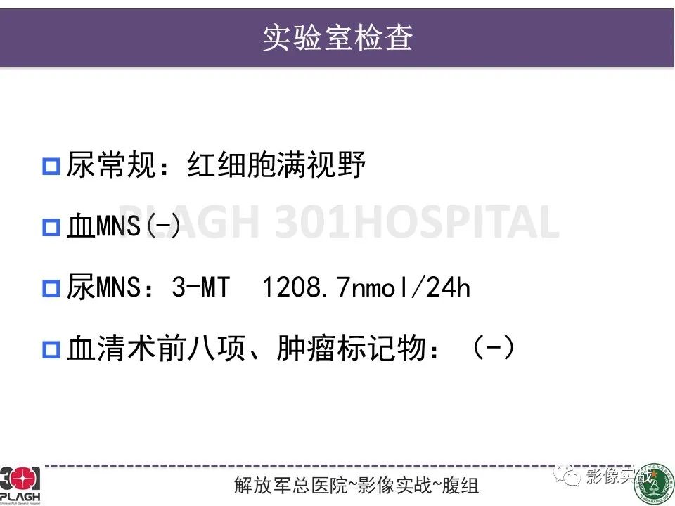 【病例】节细胞神经母细胞瘤1例CT解析思路-3