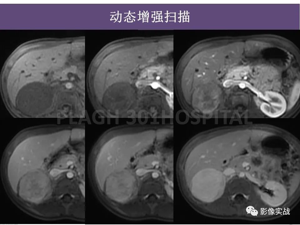 【病例】节细胞神经母细胞瘤1例CT解析思路-13