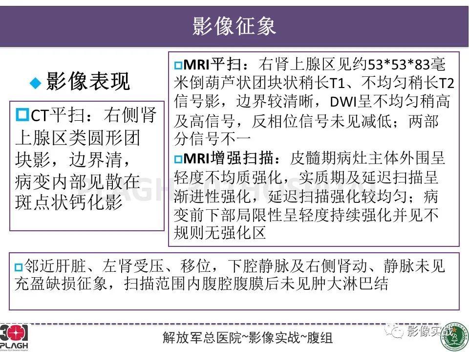 【病例】节细胞神经母细胞瘤1例CT解析思路-17