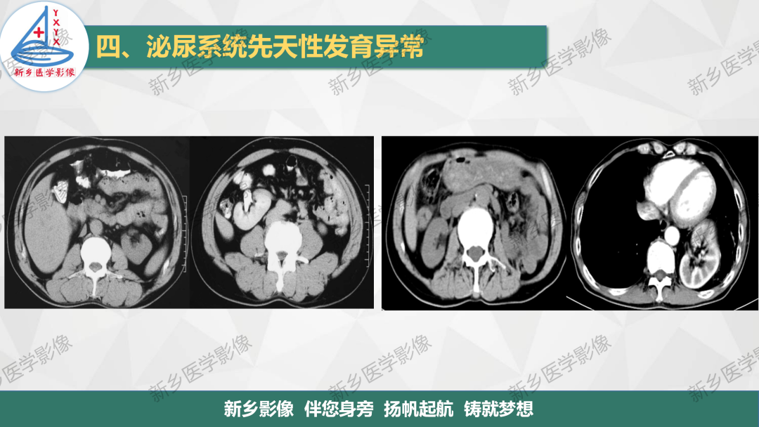 【PPT】泌尿系统先天性发育异常影像表现-8