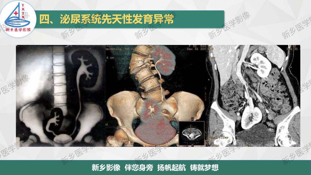 【PPT】泌尿系统先天性发育异常影像表现-7