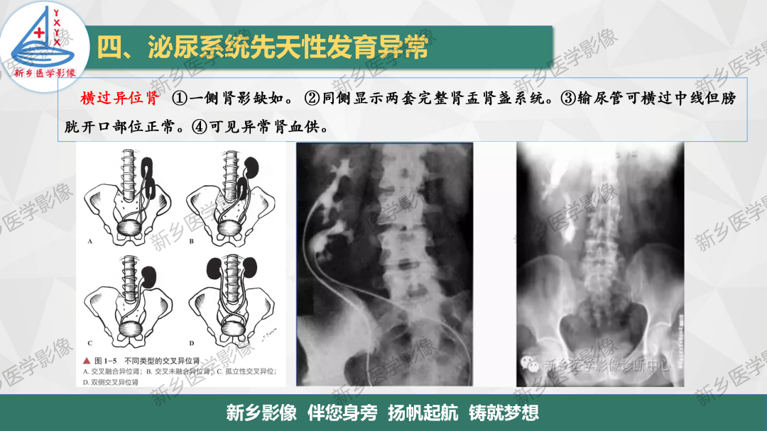 【PPT】泌尿系统先天性发育异常影像表现-9