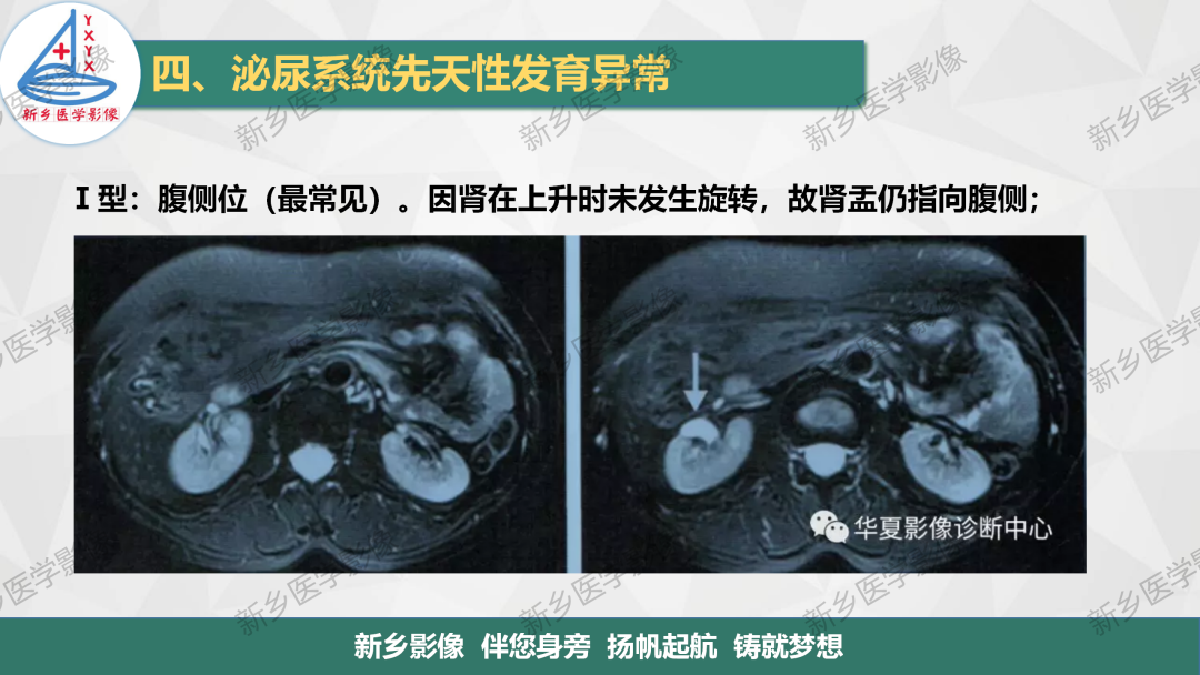 【PPT】泌尿系统先天性发育异常影像表现-12