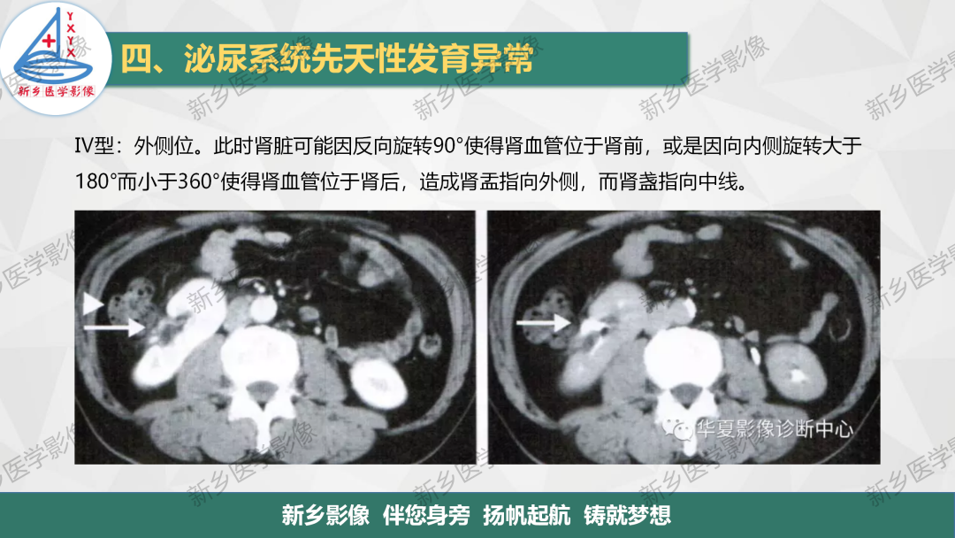 【PPT】泌尿系统先天性发育异常影像表现-15