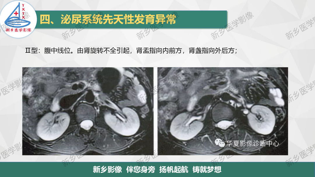 【PPT】泌尿系统先天性发育异常影像表现-13