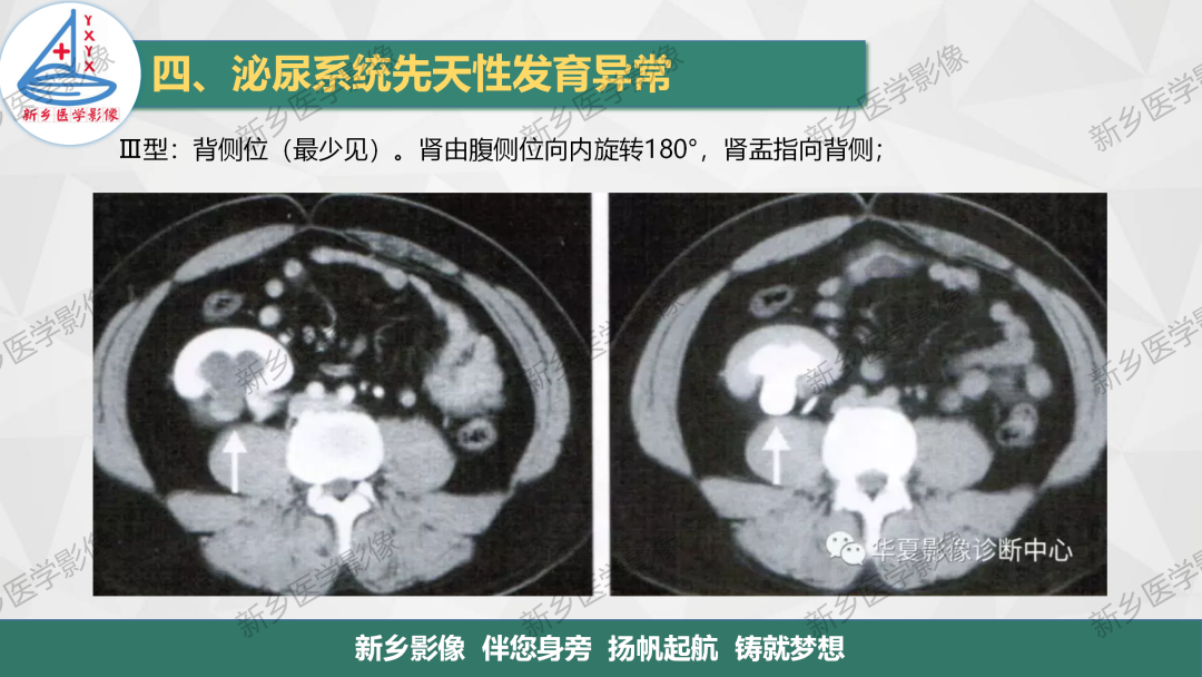 【PPT】泌尿系统先天性发育异常影像表现-14