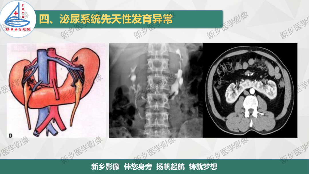 【PPT】泌尿系统先天性发育异常影像表现-17