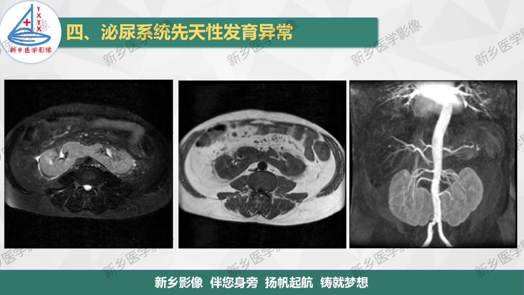 【PPT】泌尿系统先天性发育异常影像表现-18