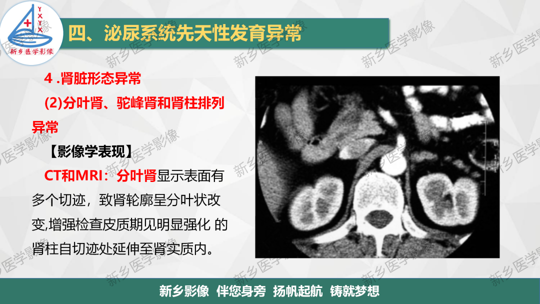 【PPT】泌尿系统先天性发育异常影像表现-20