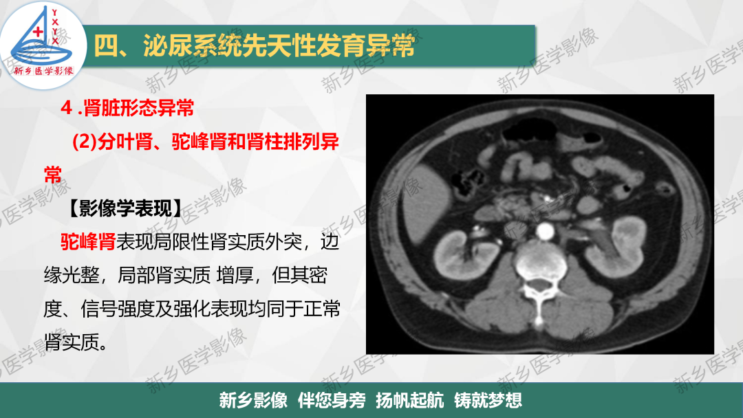 【PPT】泌尿系统先天性发育异常影像表现-21