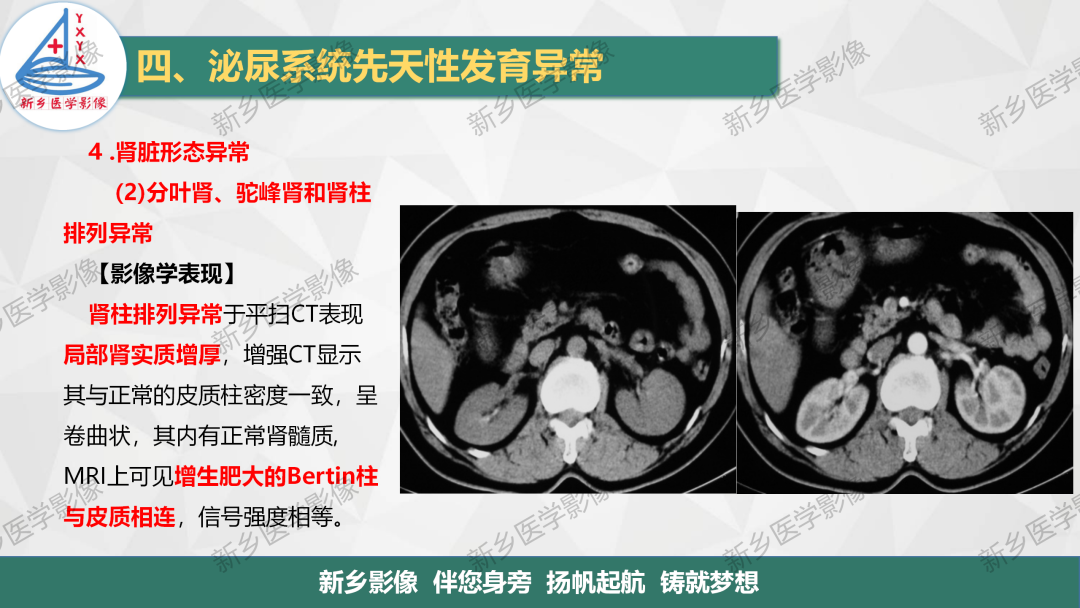 【PPT】泌尿系统先天性发育异常影像表现-22