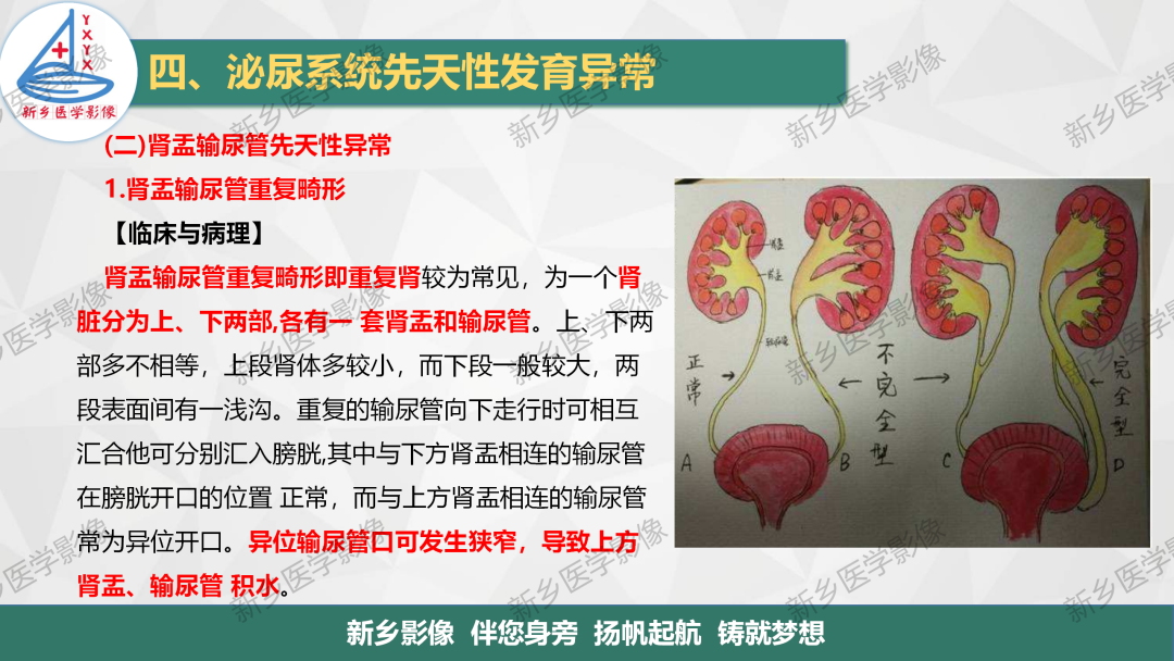 【PPT】泌尿系统先天性发育异常影像表现-24