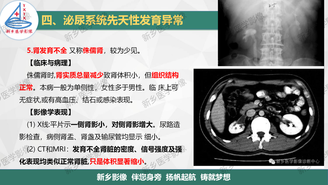 【PPT】泌尿系统先天性发育异常影像表现-23
