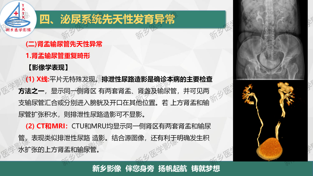 【PPT】泌尿系统先天性发育异常影像表现-25