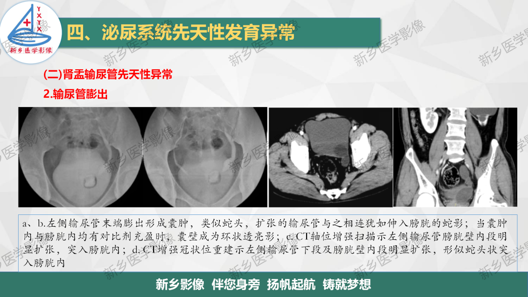 【PPT】泌尿系统先天性发育异常影像表现-27