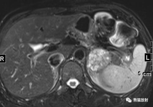 【病例】肾上腺碰撞瘤1例影像表现-1