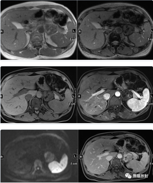 【病例】肾上腺碰撞瘤1例影像表现-2