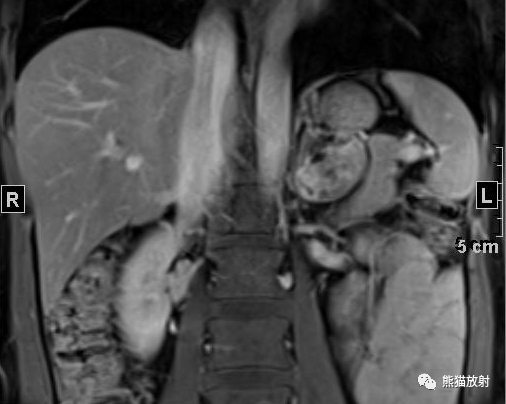 【病例】肾上腺碰撞瘤1例影像表现-3