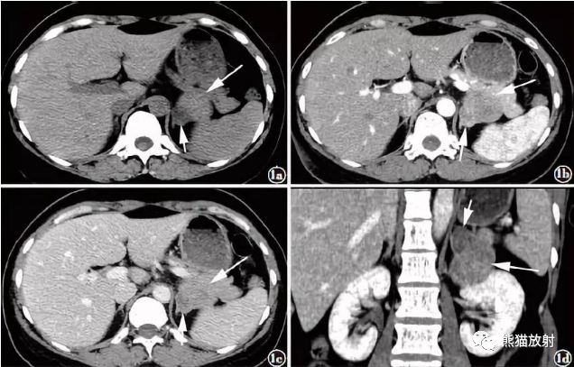 【病例】肾上腺碰撞瘤1例影像表现-5