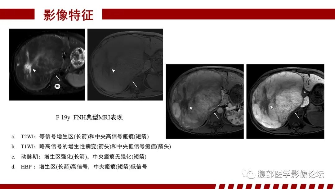 【PPT】肝胆期高信号的病变影像表现及临床意义-15
