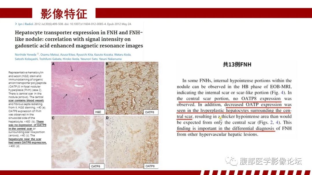 【PPT】肝胆期高信号的病变影像表现及临床意义-18