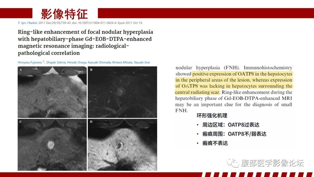 【PPT】肝胆期高信号的病变影像表现及临床意义-17