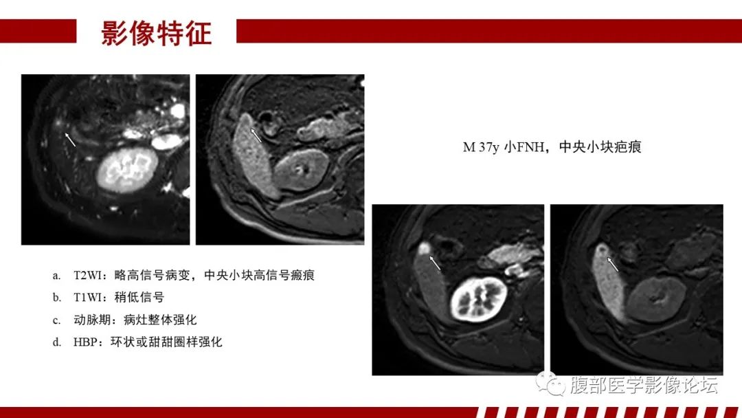 【PPT】肝胆期高信号的病变影像表现及临床意义-20