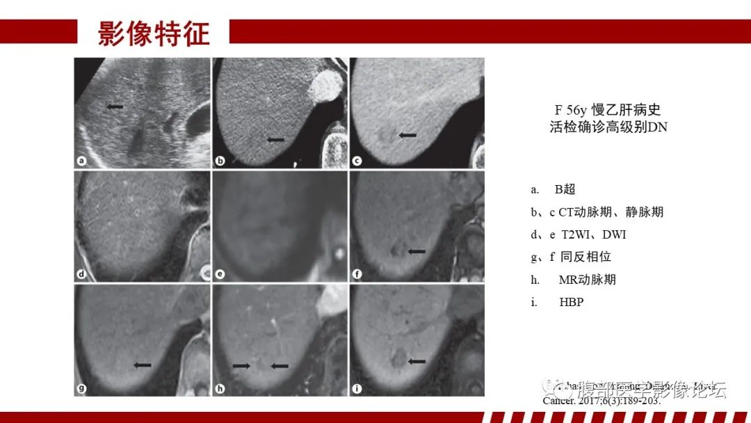 【PPT】肝胆期高信号的病变影像表现及临床意义-28