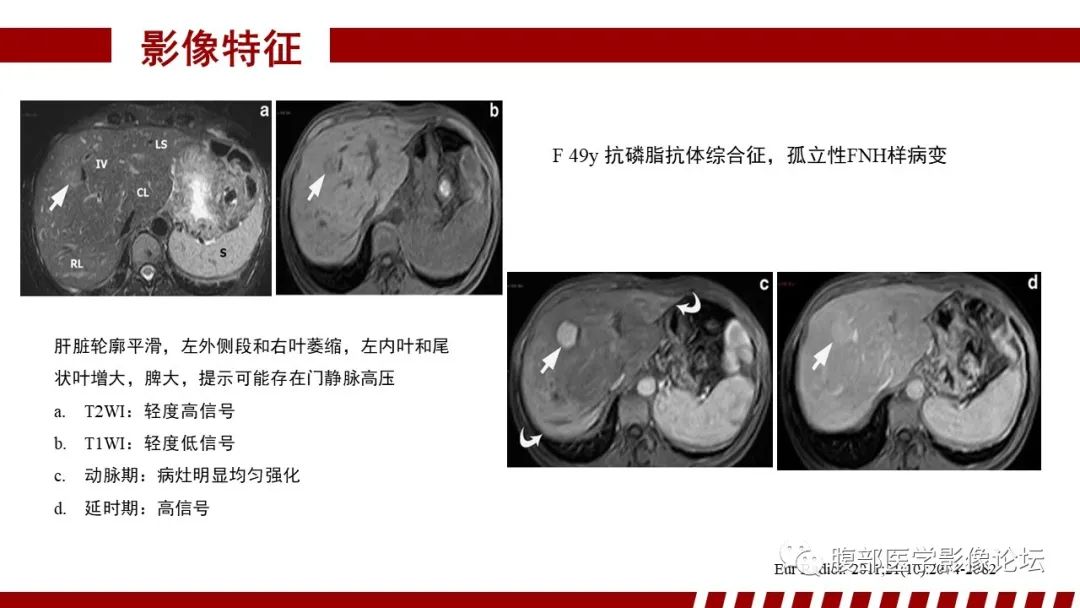【PPT】肝胆期高信号的病变影像表现及临床意义-25