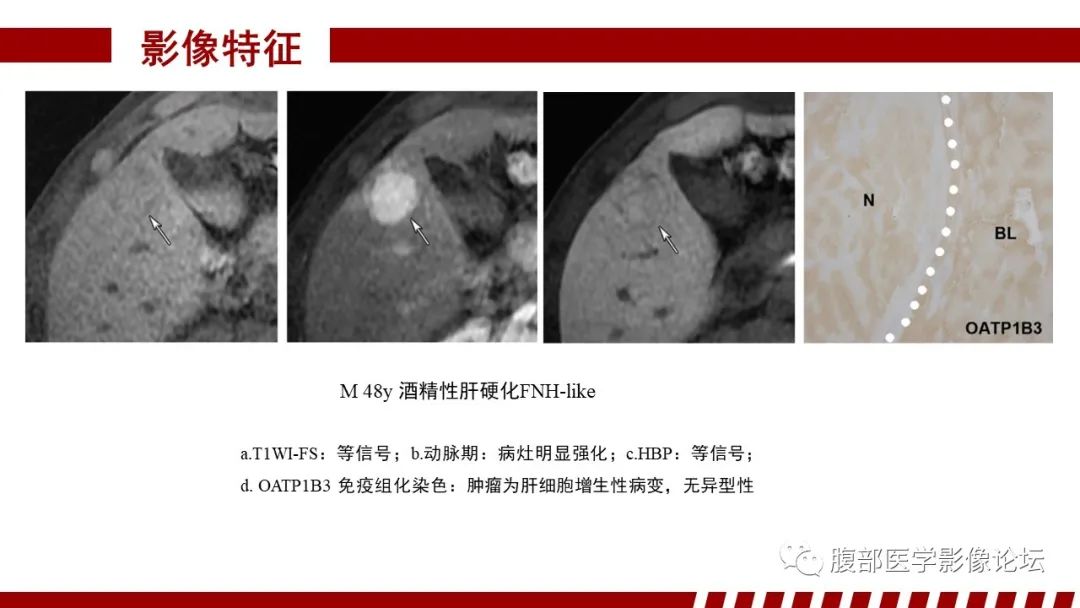 【PPT】肝胆期高信号的病变影像表现及临床意义-24