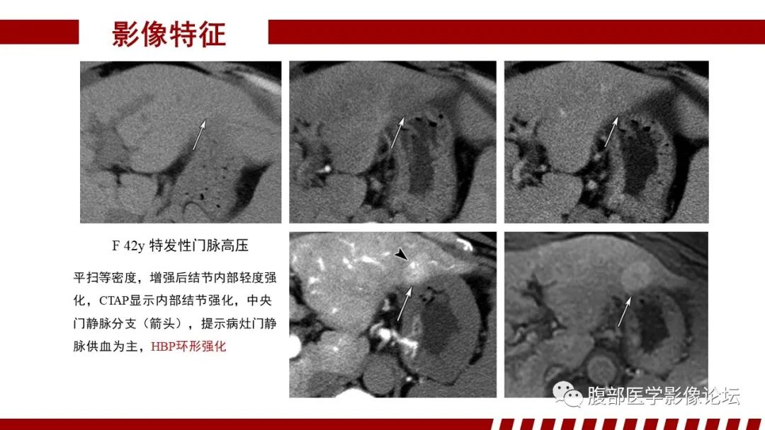 【PPT】肝胆期高信号的病变影像表现及临床意义-32