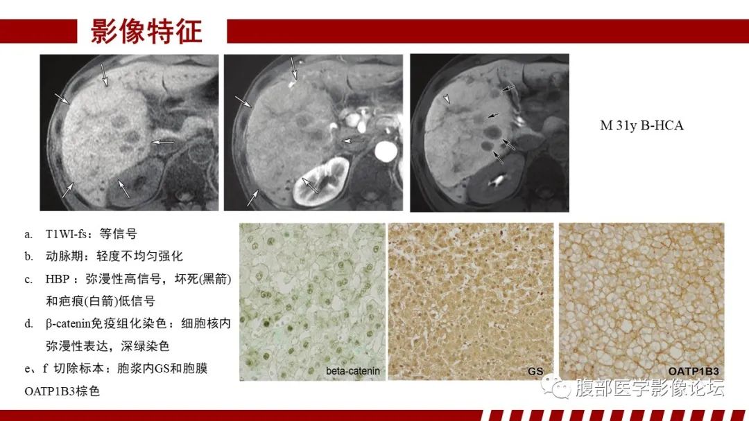 【PPT】肝胆期高信号的病变影像表现及临床意义-38