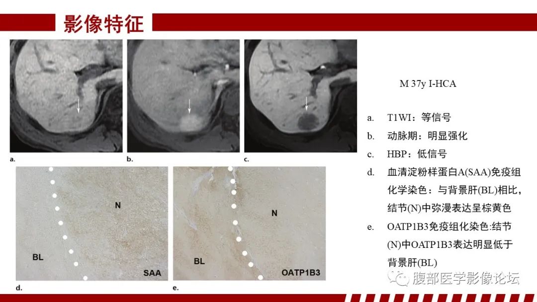 【PPT】肝胆期高信号的病变影像表现及临床意义-40