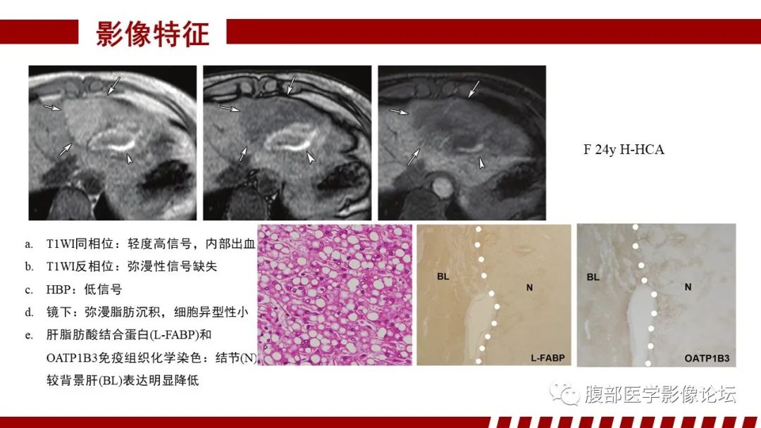 【PPT】肝胆期高信号的病变影像表现及临床意义-43
