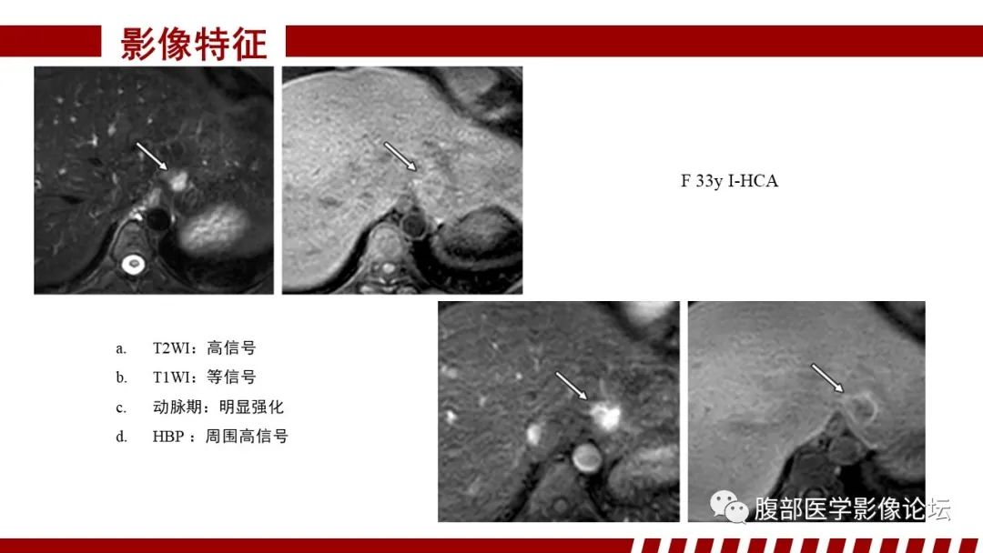 【PPT】肝胆期高信号的病变影像表现及临床意义-41