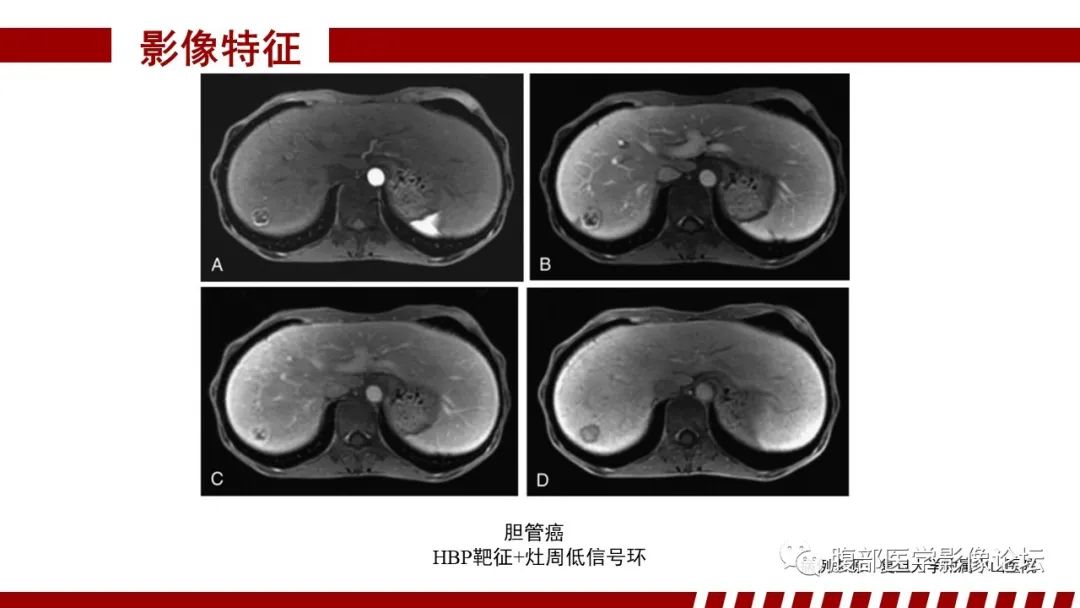 【PPT】肝胆期高信号的病变影像表现及临床意义-50
