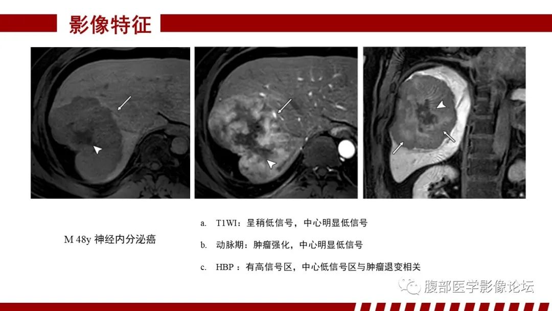 【PPT】肝胆期高信号的病变影像表现及临床意义-52